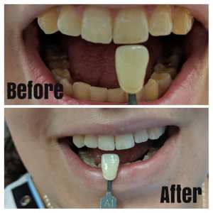 Before and after results of teeth whitening