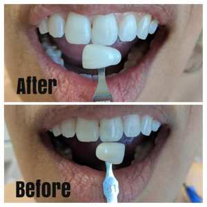 Before and after results of teeth whitening